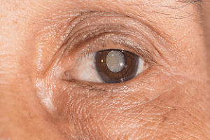 причины катаракты