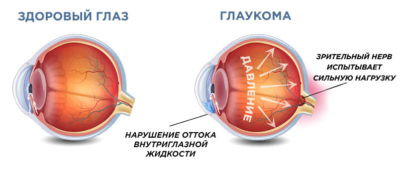 болезнь глаукома
